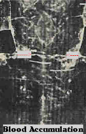 Blood Accumulation In The Small Of The Back